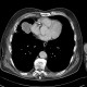 Metastatic disease of lung, pleural metastases: CT - Computed tomography
